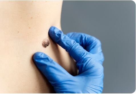 Skin Cancer Surgery